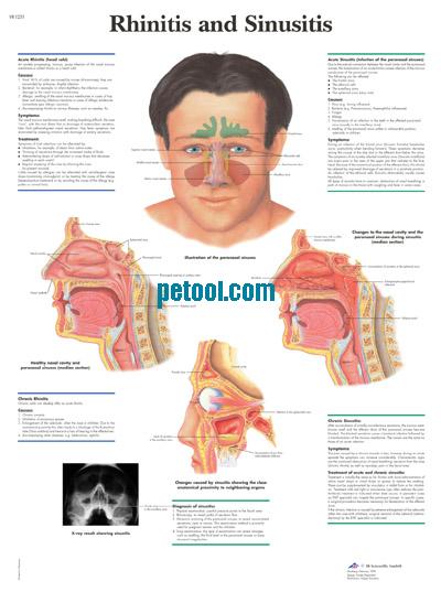 ¹Ȧ Rhinitis and Sinusitis